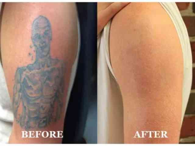 What’s The Cost Of Tattoo Removal?