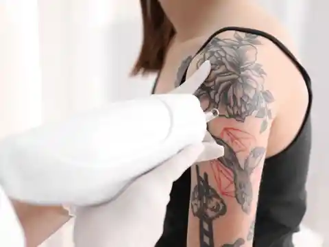 How Does Tattoo Removal Function?