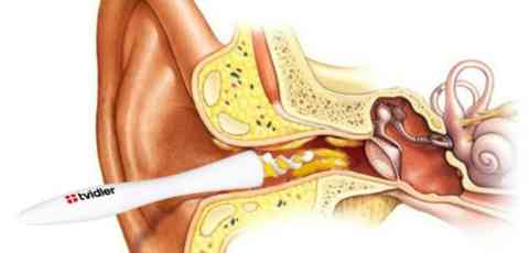 Q-Tips Are Dangerous And Ineffective. This Is How You’re Supposed To Clean Your Ears